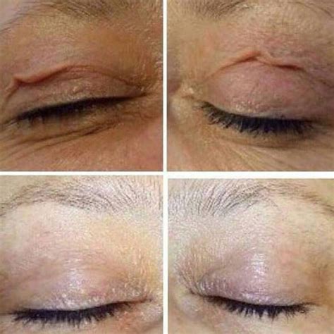 Plasma Pen™ Ema Skin Aesthetics Preston Ema Skin Aesthetics Preston