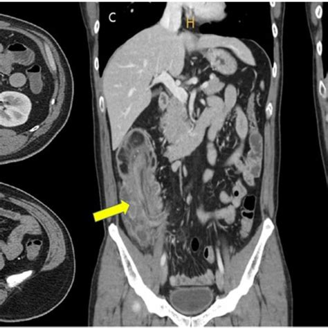 Abdominal Pelvic CT Scan Ileocolonic Intussusception With Mechanical