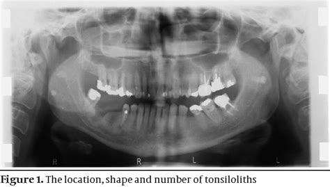 Tonsilloliths Radiograph