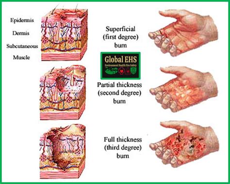 Burns First Aid Guide