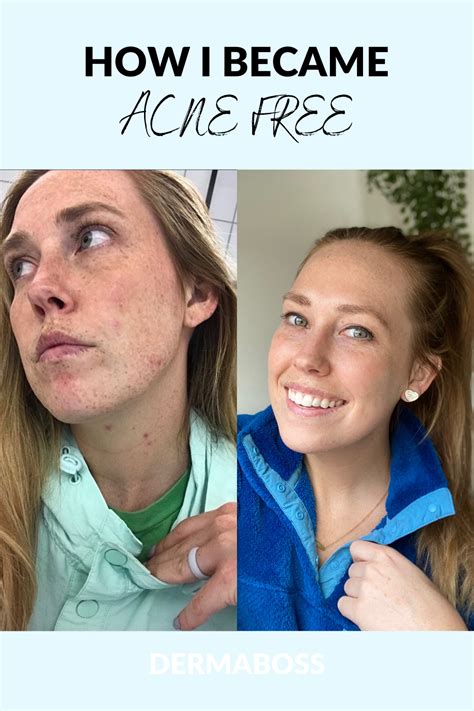 Acne Org Before And After How I Cleared My Cystic Acne Artofit