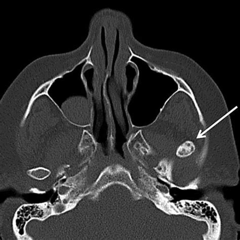 Pdf Jaw Dislocation As An Unusual Complication Of Upper Endoscopy