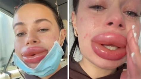 Botched lip filler injection nightmare for influencer Jessica Burko ...