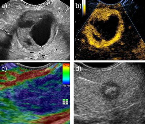 Endosonography Ai Takes On The “supreme Discipline” • Healthcare In