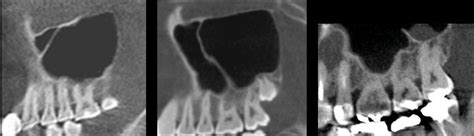 Prevalence And Morphological Variations Of Maxillary Sinus Septa In