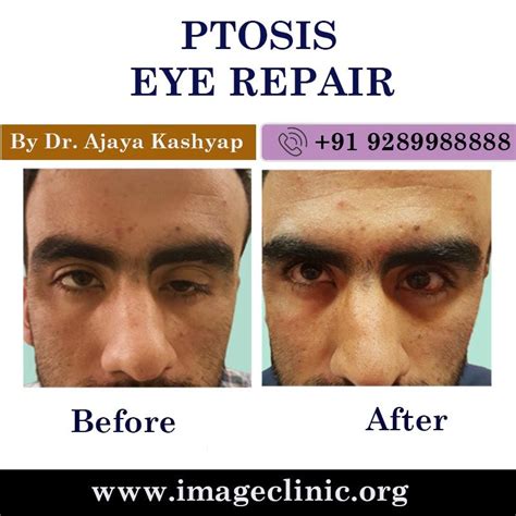 Ptosis Eye Repair Surgery In Delhi Chirurgie