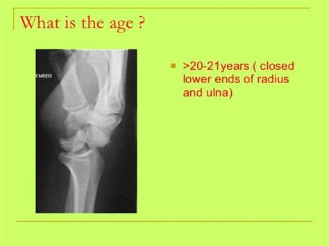 Bone Age Estimation