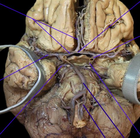 Circle Of Willis Diagram Quizlet