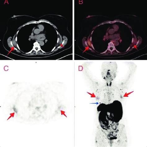 I Mibg And Ga Dotatoc Pet Ct Of A Month Old Patient With