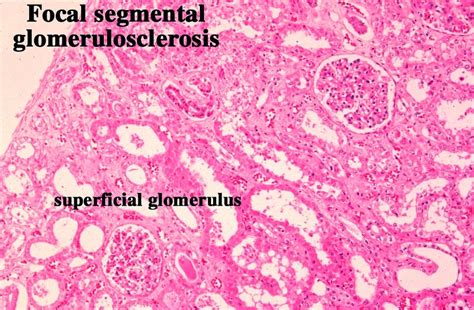 Pathology Outlines Focal And Segmental Glomerulosclerosis