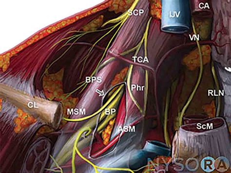 Nerve Block Tip Of The Week Interscalene Brachial Plexus Block Nysora