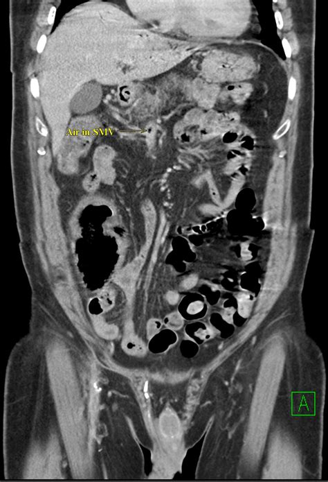 Ischemic Colitis Image Radiopaedia Org