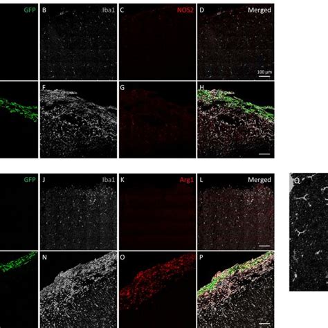 Infiltrating Microglia And Macrophages Were Dominantly M Phenotype