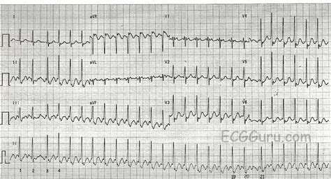 Atrial Flutter With 21 Conduction Ecg Guru Instructor Resources