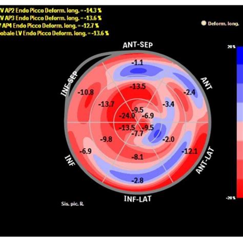 Bull Eye Depicting Longitudinal Strain Of The Lv By Speckle Tracking