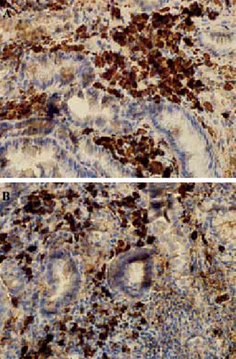 Gastric Biopsy Showing Diffuse Infiltration Of Lamina Propria By