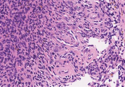 Histopathology Of The Tumor A The Tumor Was Composed Of Sheet Like