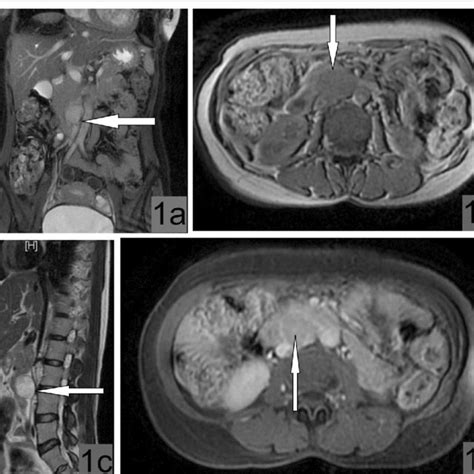 A Tumor Bulge Identified After Colon Mobilization And Kocherization Of