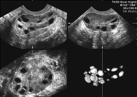 Normal Vs Polycystic Ovaries Ultrasound