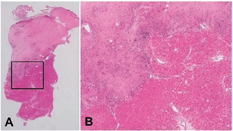 Histopathological Findings Of A Myocardial Biopsy Specimen In A Patient