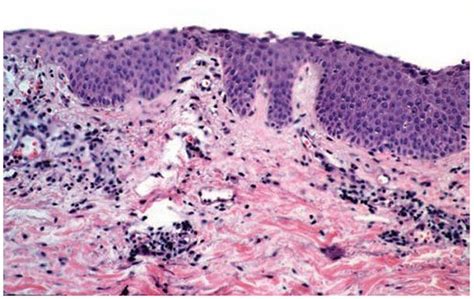 Noninfectious Vesiculobullous And Vesiculopustular Diseases Plastic