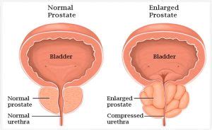 Enlarged Prostate Causes Symptoms, and Treatments | Prosman