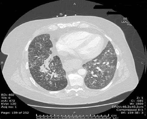 Ct Lung Windows Diffuse Bilateral Interstitial Infiltrates With Tree