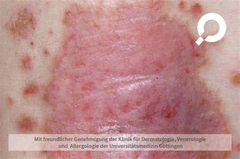 Pityriasis Rosea R Schenflechte Dermanostic