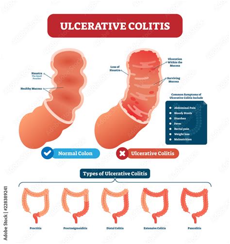 Ulcerative Colitis Vector Illustration Labeled Anatomical Infographic