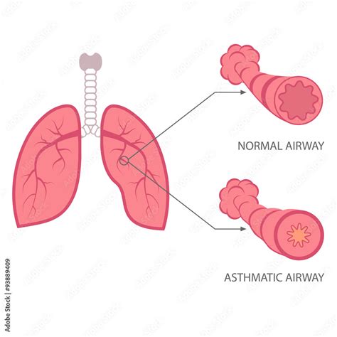 Vector Asthma Illustration Bronchial Lungs Respiratory Disease Stock