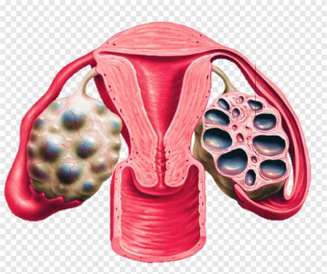 Polycystic ovary syndrome Ovarian cyst Disease, surgical tools, disease, androgen png | PNGEgg