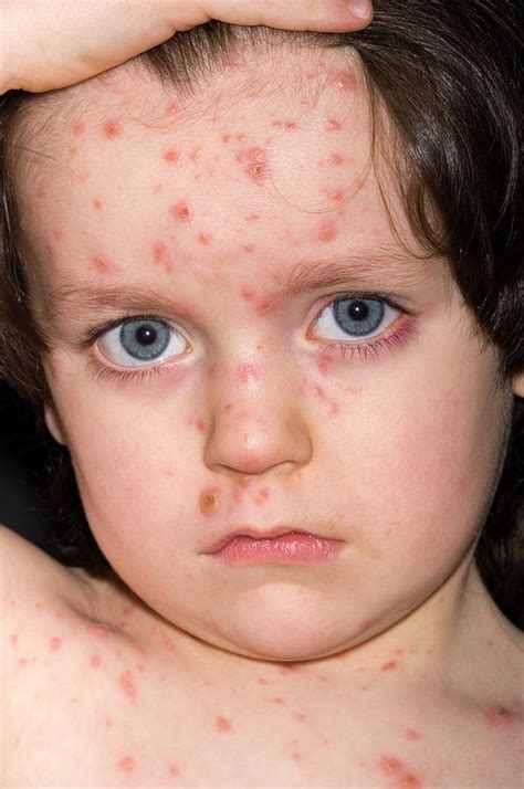 What Is Chicken Pox Called In Adults At Douglas Reddin Blog
