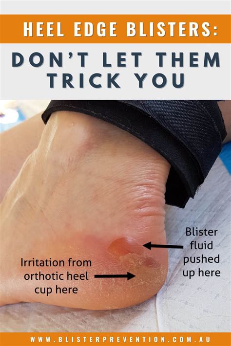 Heel Edge Blisters They Can Trick You Blisters Blister Treatment