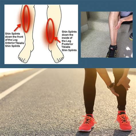 Shin Splints Tibial Stress Syndrome Sole Remedy Foot Care