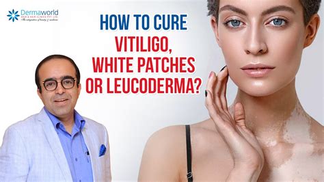 How To Cure Vitiligo White Patches Or Leucoderma Youtube