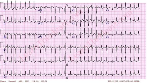 Atrial Fibrillation With Rvr