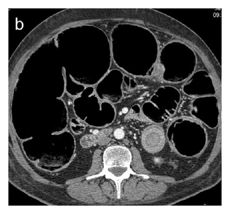 Enteroenteric Ileoileal Intussusception Secondary To Colic