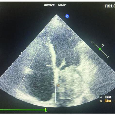 Transthoracic Echocardiography Apical Four Chamber View Showing A