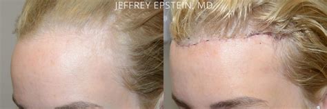 Forehead Reduction Surgery Photos Miami FL Patient37369