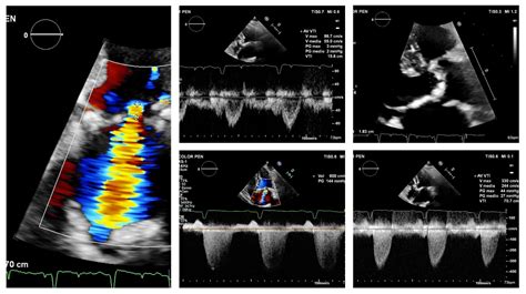 Jcm Free Full Text The Common Combination Of Aortic Stenosis With