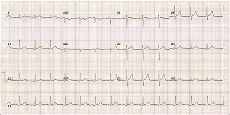 ECG Interpretation