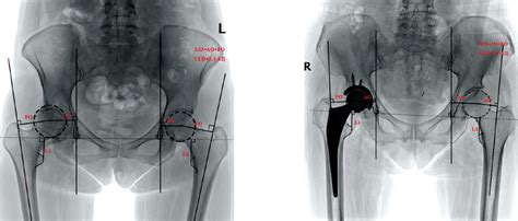 Illustrative A Preoperative And B Postoperative Anteroposterior