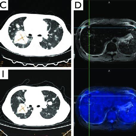 Ct Pet Mri And Pet Ct Scans Evaluate The Progression Of Disease A C