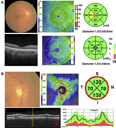 Quantitative Assessment Of The Retina Using Oct And Associations With