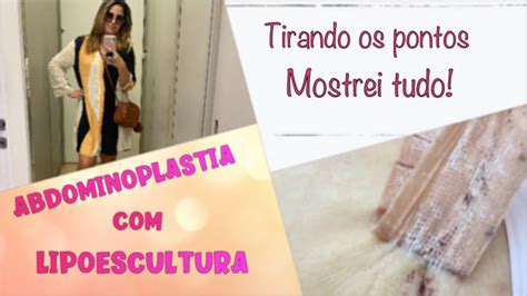 Tirando Os Pontos Sem Corte Abdominoplastia Lipoescultura Por