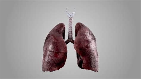 Healthy Human Lungs Vs Smoker Lungs Isolated On White 동영상 1404034059