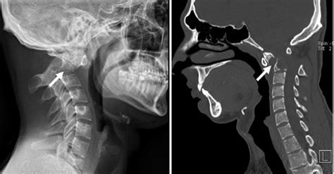 X-ray/CT scan of the cervical spine revealed the pathological C2... | Download Scientific Diagram