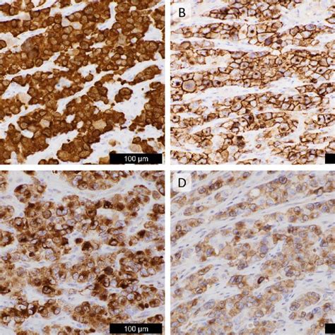 Immunohistochemical Images Of The Anaplastic Lymphoma Kinase Positive