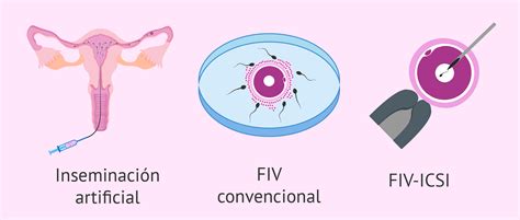 Las técnicas de reproducción asistida diferencias y complejidad