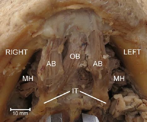 Inferior View Of The Variant Digastric Musculature Demonstrating An